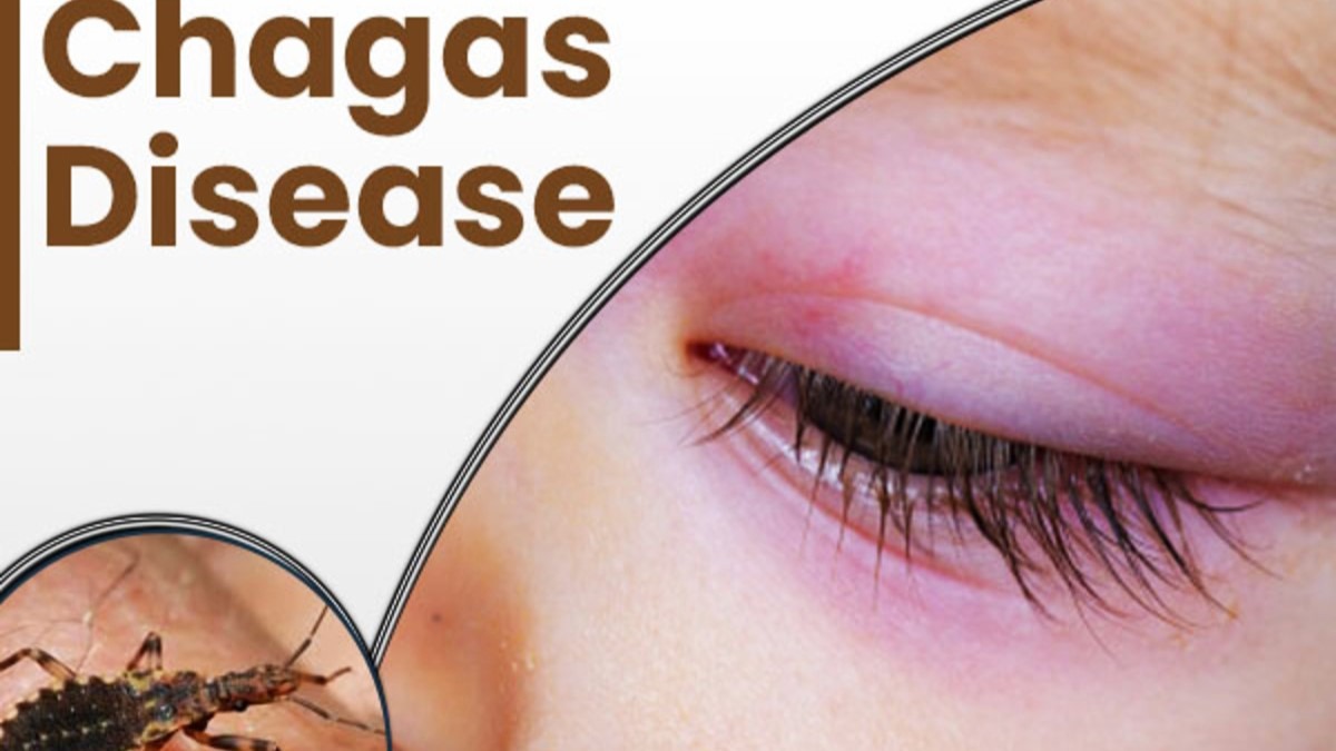 What is Chagas Disease, which can become a silent killer, know all the important things related to it?